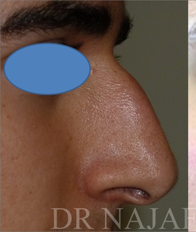 Rhinoplasty before and after - before