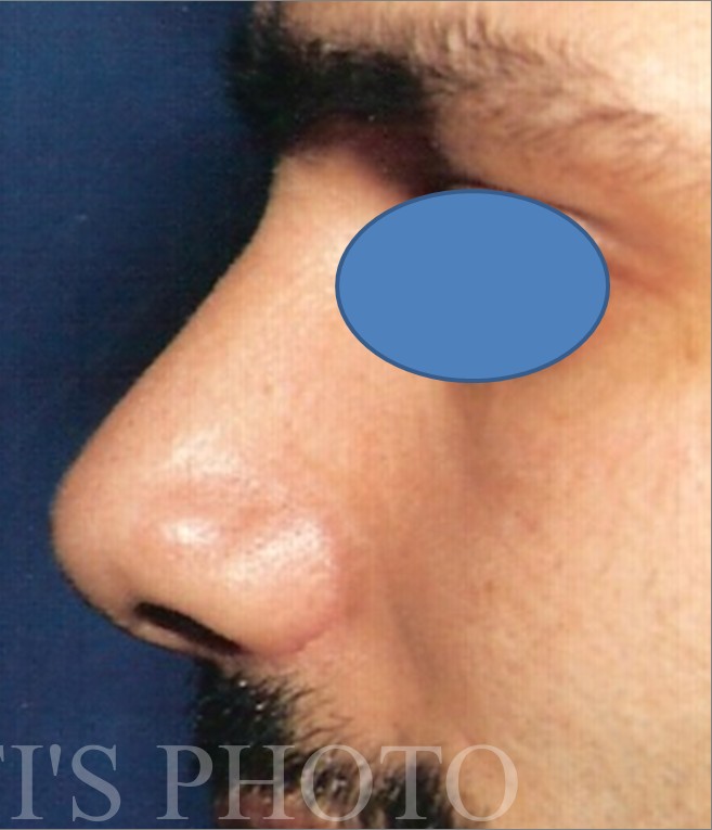 Rhinoplasty before and after - after
