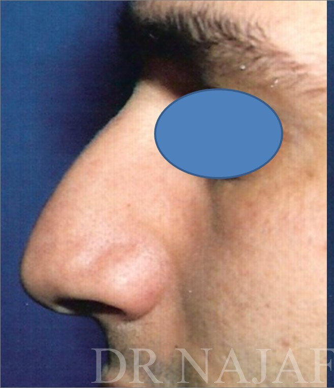 Rhinoplasty before and after - before