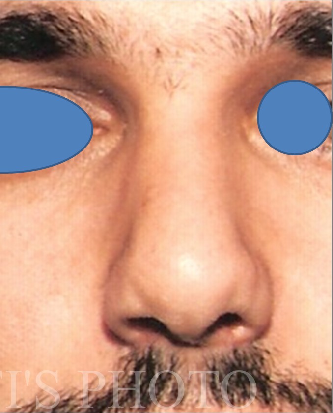 Rhinoplasty before and after - after
