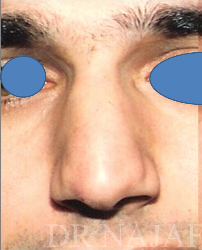 Rhinoplasty before and after - before