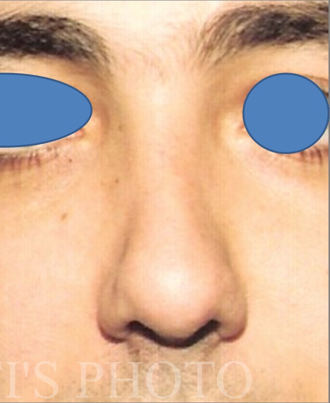 Rhinoplasty before and after - after