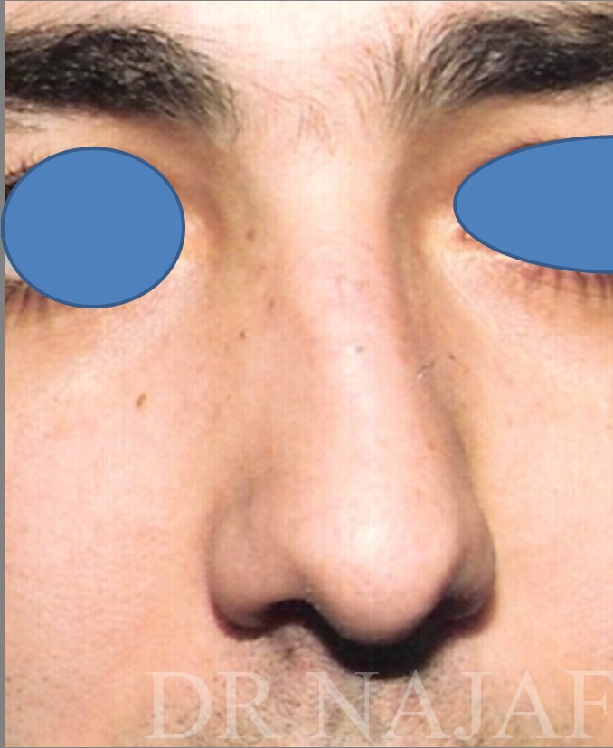 Rhinoplasty before and after - before