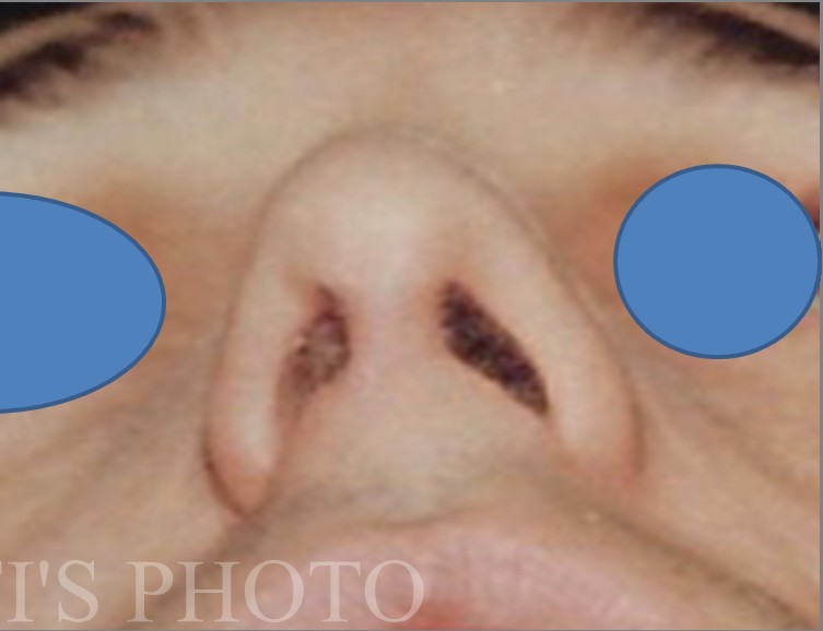 Rhinoplasty before and after - after