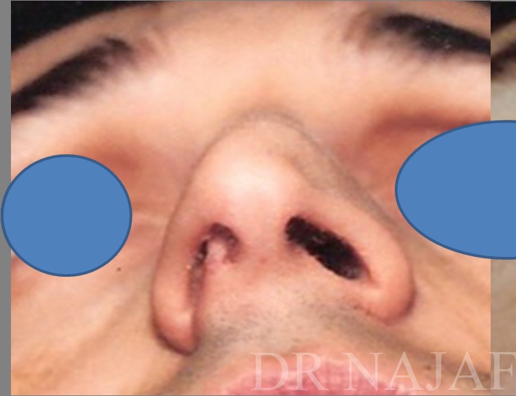 Rhinoplasty before and after - before