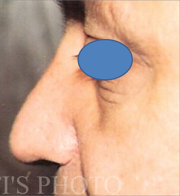 Rhinoplasty before and after - after