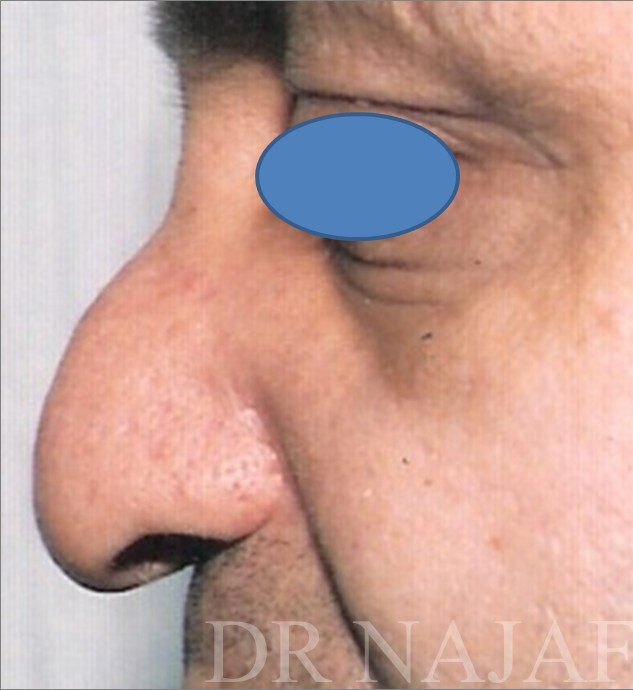 Rhinoplasty before and after - before