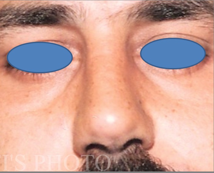 Rhinoplasty before and after - after