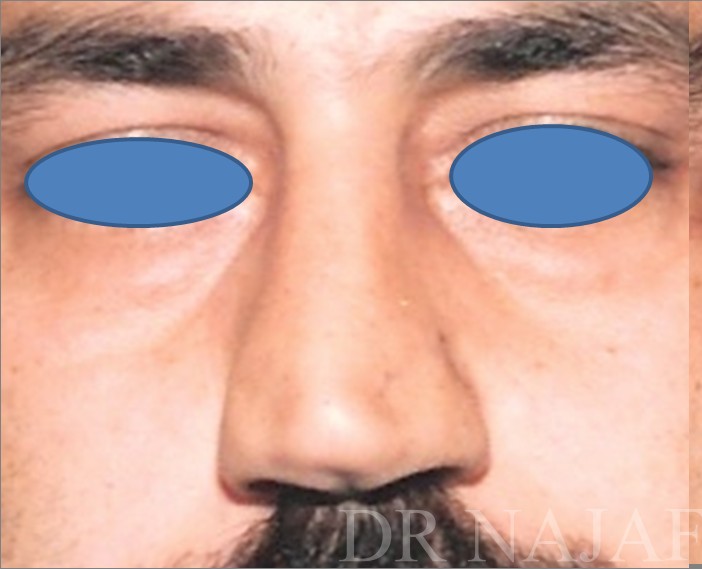 Rhinoplasty before and after - before