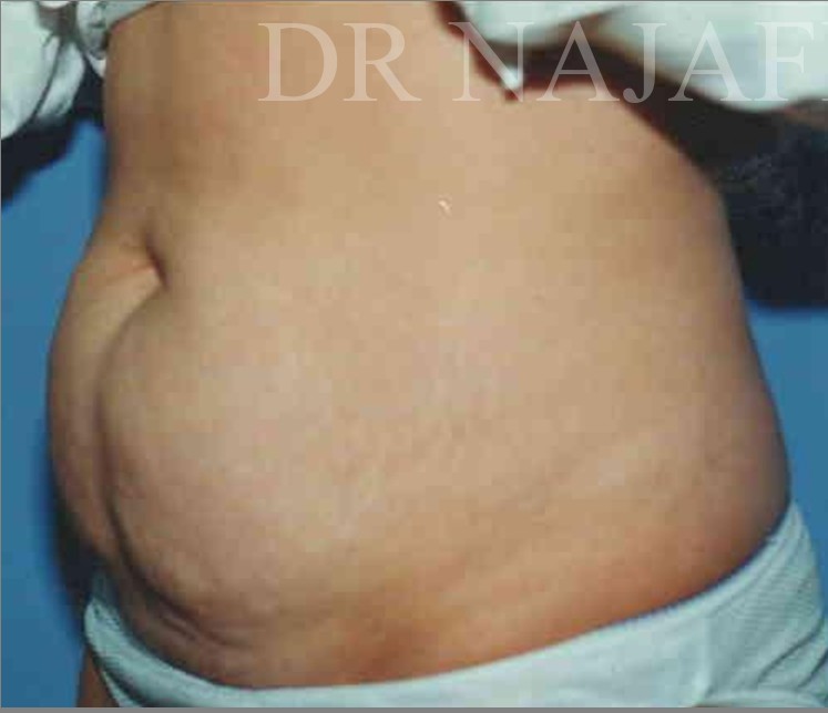 Tummy Tuck before and after - before