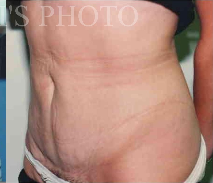 Tummy Tuck before and after - after