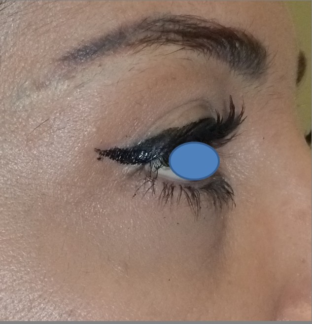 Blepharoplasty before and after - after
