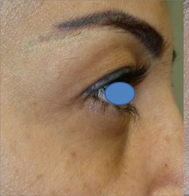 Blepharoplasty before and after - before