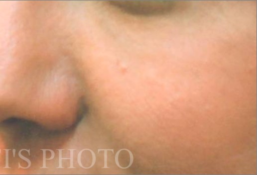 Blepharoplasty before and after - after