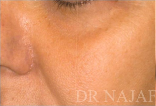 Blepharoplasty before and after - before
