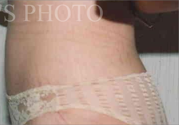 Tummy Tuck before and after - after