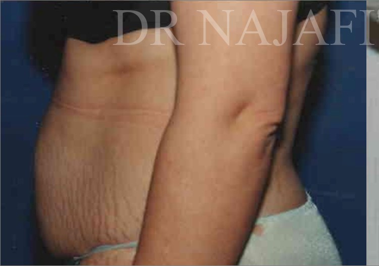 Tummy Tuck before and after - before