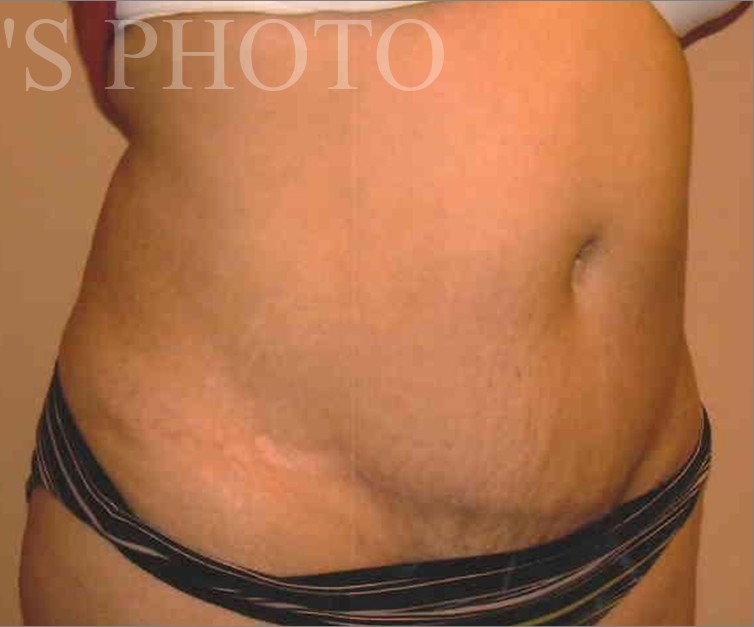 Tummy Tuck before and after - after