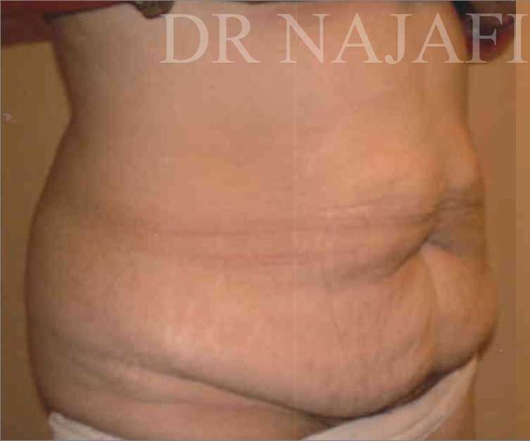 Tummy Tuck before and after - before