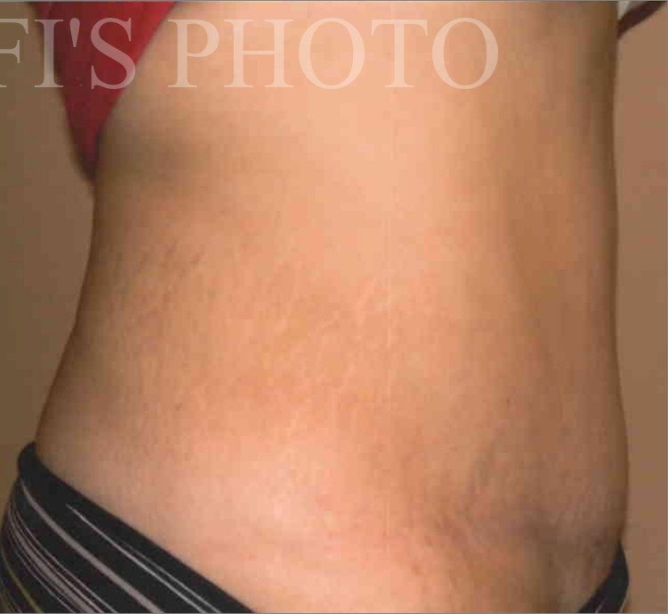 Tummy Tuck before and after - after