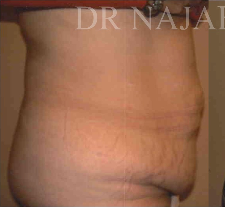 Tummy Tuck before and after - before
