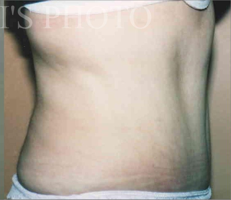 Tummy Tuck before and after - after