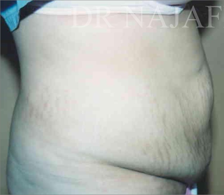 Tummy Tuck before and after - before