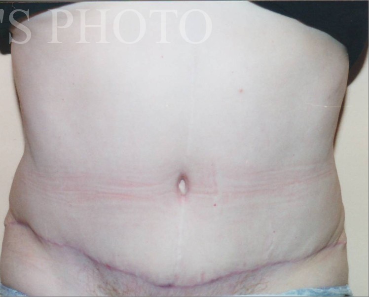 Tummy Tuck before and after - after