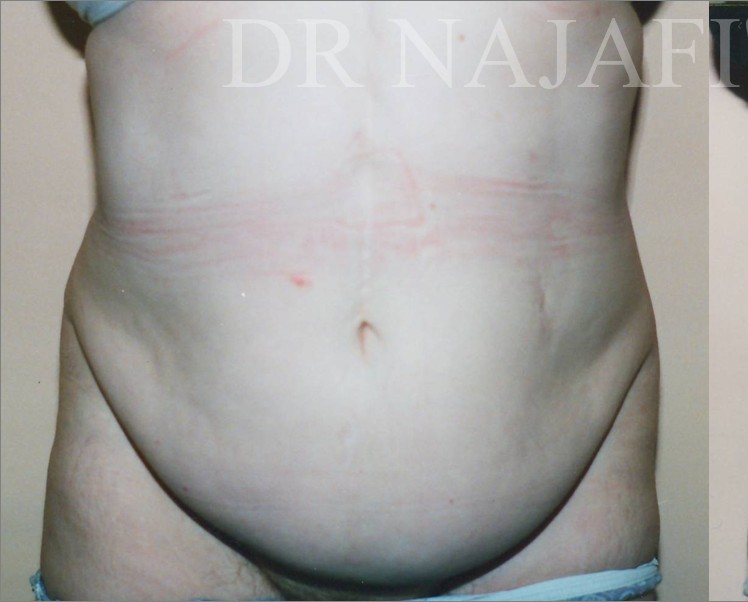 Tummy Tuck before and after - before