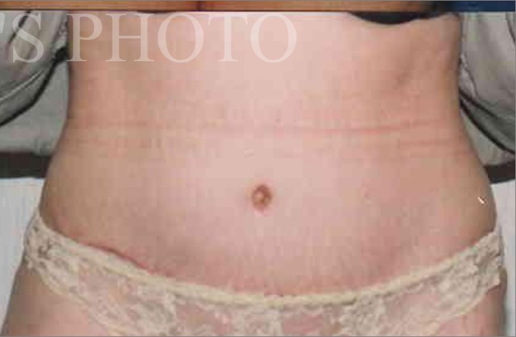 Tummy Tuck before and after - after