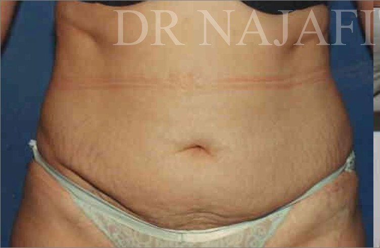 Tummy Tuck before and after - before