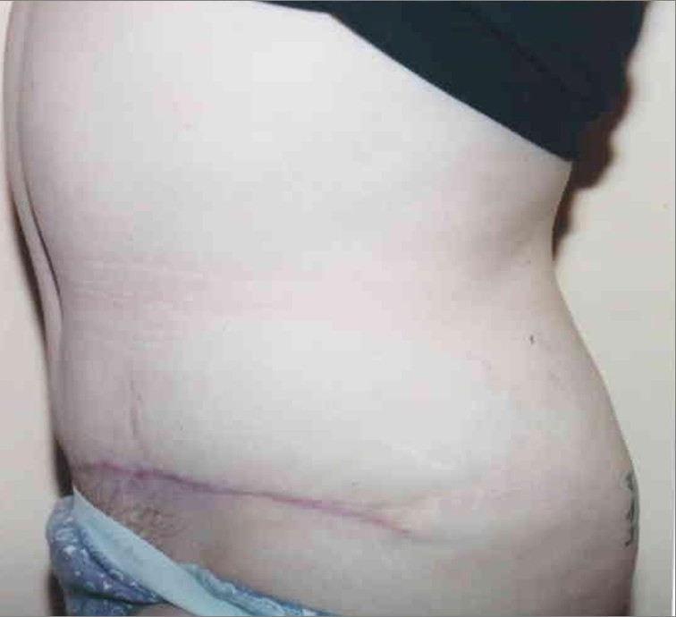 Tummy Tuck before and after - after