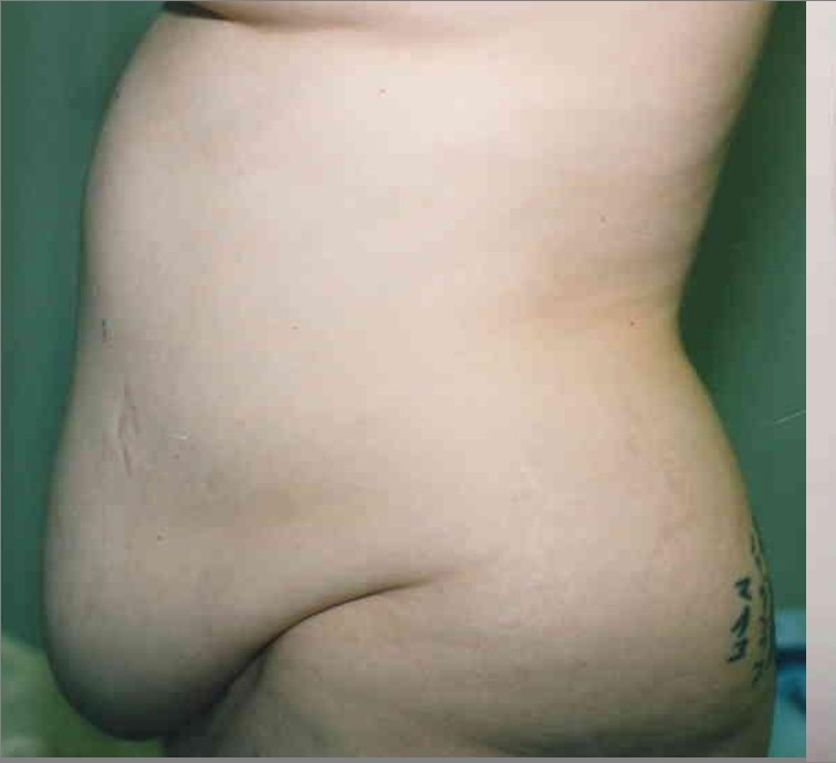 Tummy Tuck before and after - before
