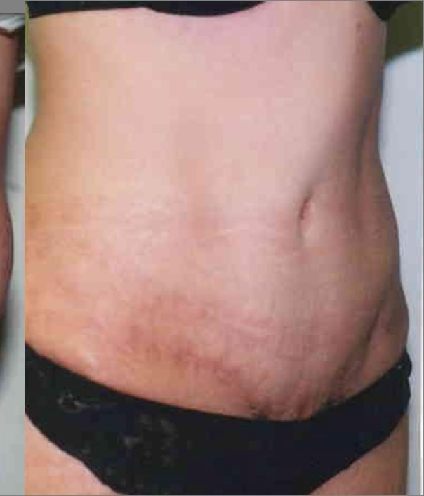 Tummy Tuck before and after - after