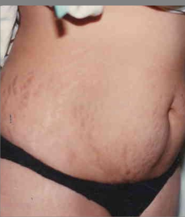 Tummy Tuck before and after - before