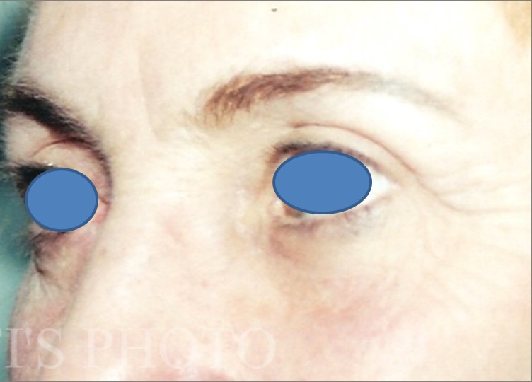 Blepharoplasty before and after - after