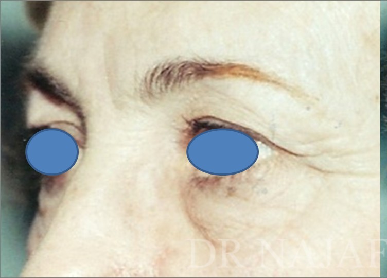 Blepharoplasty before and after - before