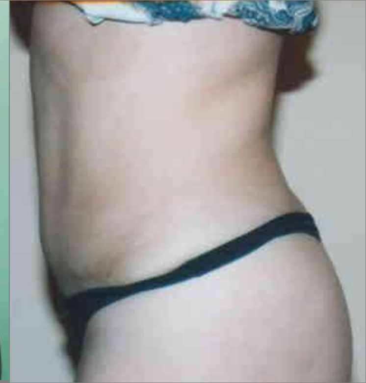 Tummy Tuck before and after - after