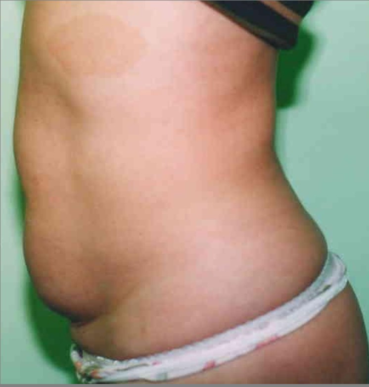 Tummy Tuck before and after - before