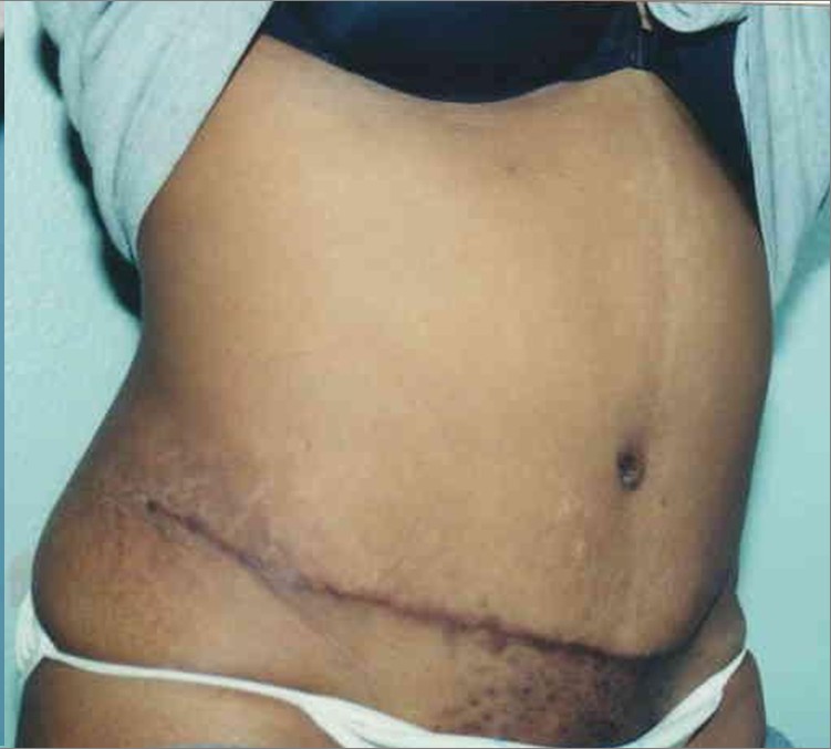 Tummy Tuck before and after - after