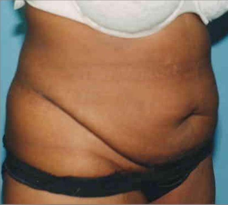 Tummy Tuck before and after - before
