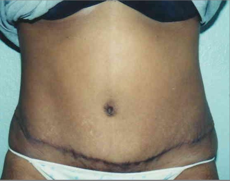 Tummy Tuck before and after - after
