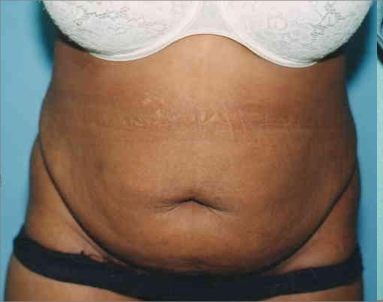 Tummy Tuck before and after - before