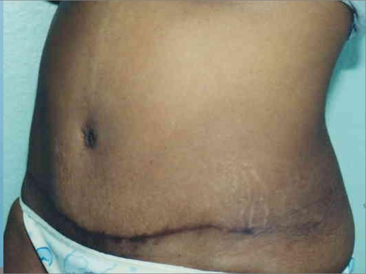 Tummy Tuck before and after - after