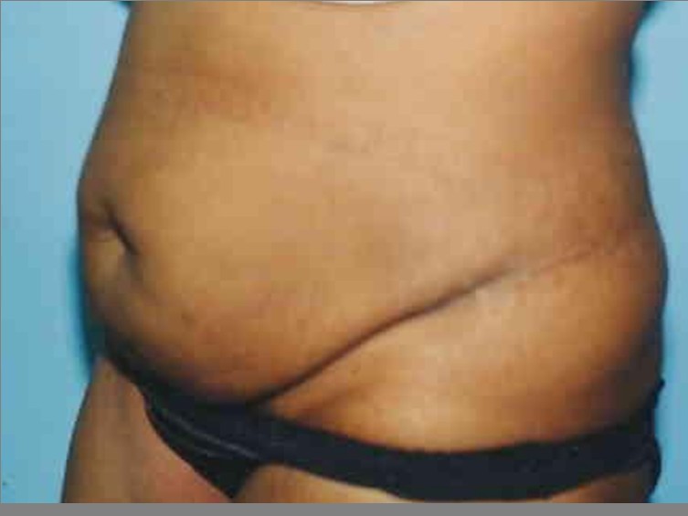 Tummy Tuck before and after - before