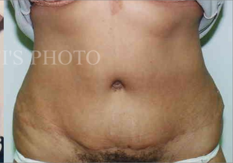 Tummy Tuck before and after - after