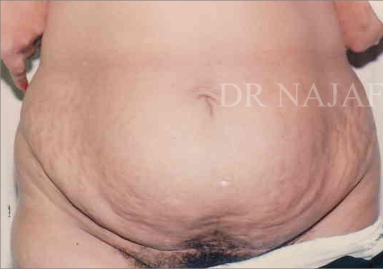 Tummy Tuck before and after - before