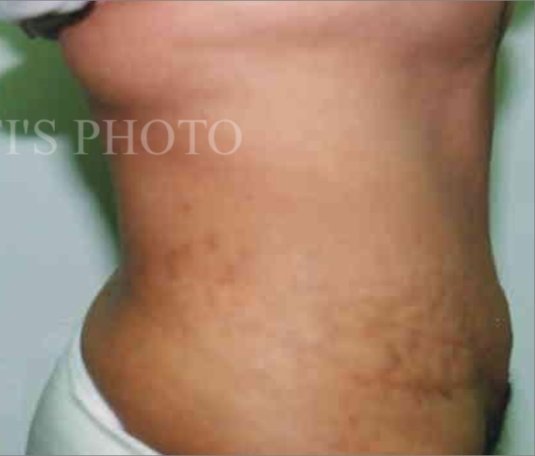 Tummy Tuck before and after - after
