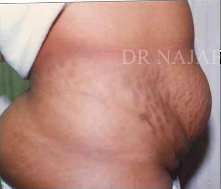 Tummy Tuck before and after - before
