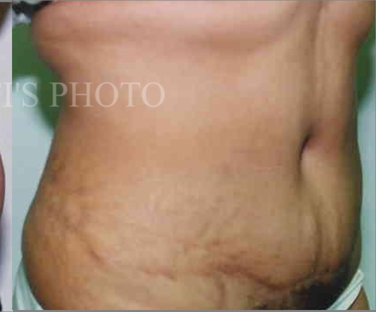 Tummy Tuck before and after - after
